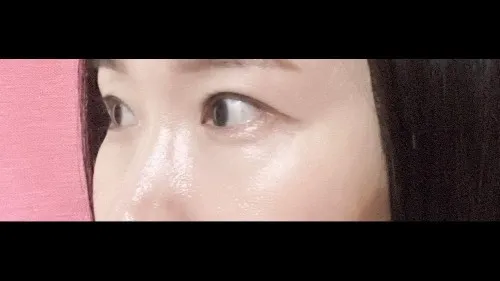 部分切開二重術, 目つき矯正, 目つき矯正再手術 — RE&RE PLASTIC SURGERY 4