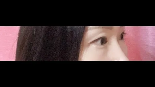 部分切開二重術, 目つき矯正, 目つき矯正再手術 — RE&RE PLASTIC SURGERY 5