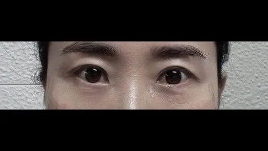 Sub-brow Lift — RE&RE PLASTIC SURGERY 2