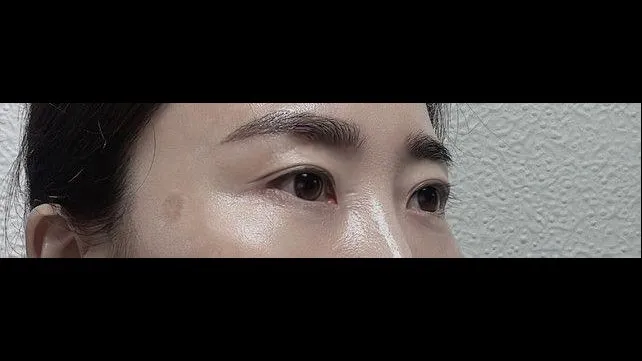 Sub-brow Lift — RE&RE PLASTIC SURGERY 3