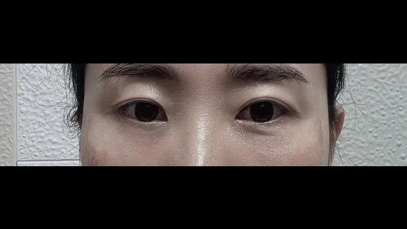 Sub-brow Lift — RE&RE PLASTIC SURGERY 4