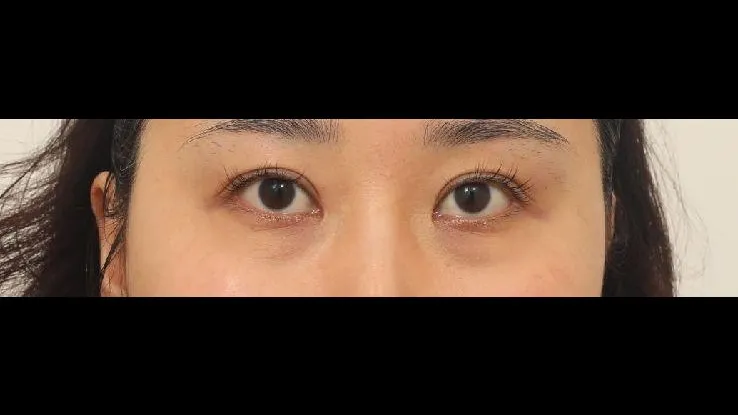 切開法(二重), ラインを低くする, 目の下脂肪再配置, 目の下脂肪移植 — RE&RE PLASTIC SURGERY 1