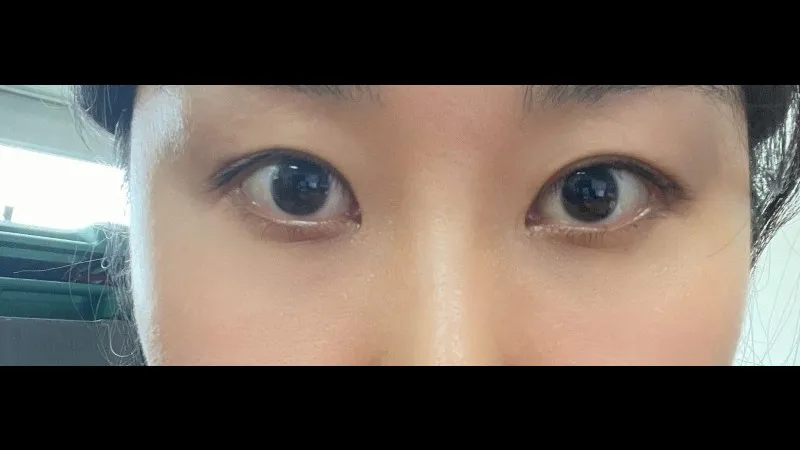 Incisional Double Eyelid Surgery, Crease lowering, Lower Eyelid Fat Repositioning, Lower Eyelid Fat Grafting 2