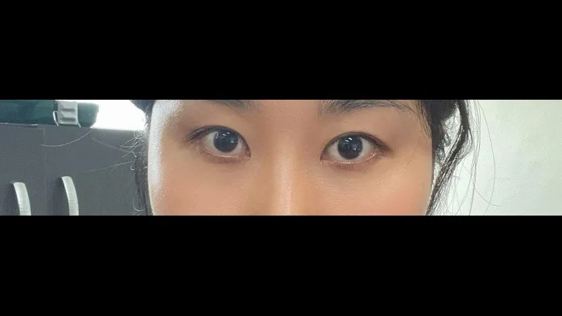 切開法(二重), ラインを低くする, 目の下脂肪再配置, 目の下脂肪移植 — RE&RE PLASTIC SURGERY 3