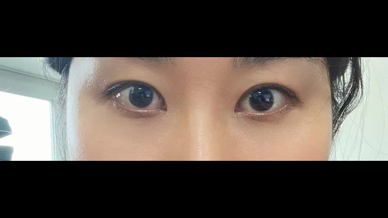 切開法(二重), ラインを低くする, 目の下脂肪再配置, 目の下脂肪移植 — RE&RE PLASTIC SURGERY 4