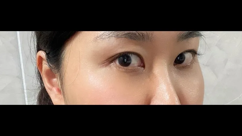 切開法(二重), ラインを低くする, 目の下脂肪再配置, 目の下脂肪移植 — RE&RE PLASTIC SURGERY 5