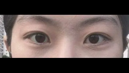 Partial Incision Double Eyelid Surgery, Ptosis Correction — RE&RE PLASTIC SURGERY 2