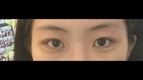 Partial Incision Double Eyelid Surgery, Ptosis Correction — RE&RE PLASTIC SURGERY 3