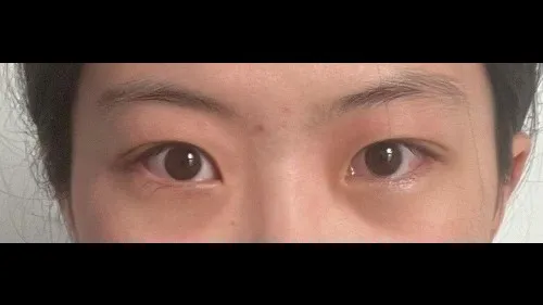 Partial Incision Double Eyelid Surgery, Ptosis Correction — RE&RE PLASTIC SURGERY 4