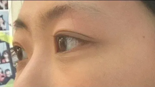 Partial Incision Double Eyelid Surgery, Ptosis Correction — RE&RE PLASTIC SURGERY 5
