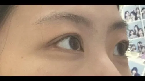 Partial Incision Double Eyelid Surgery, Ptosis Correction — RE&RE PLASTIC SURGERY 6