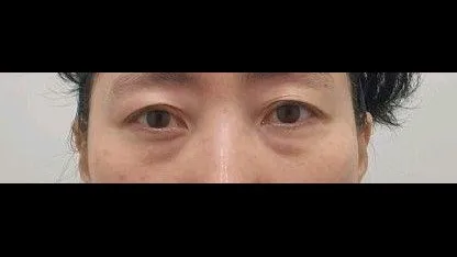 Sub-brow Lift, Lower Blepharoplasty (Aging Eye Rejuvenation), Lower Eyelid Fat Grafting — RE&RE PLASTIC SURGERY 1