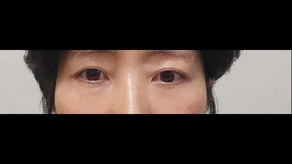 Sub-brow Lift, Lower Blepharoplasty (Aging Eye Rejuvenation), Lower Eyelid Fat Grafting — RE&RE PLASTIC SURGERY 3