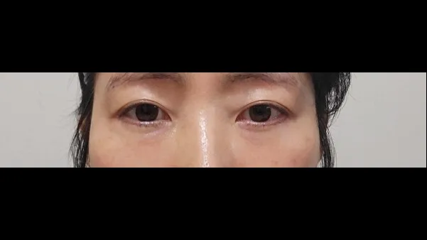 Sub-brow Lift, Lower Blepharoplasty (Aging Eye Rejuvenation), Lower Eyelid Fat Grafting — RE&RE PLASTIC SURGERY 4