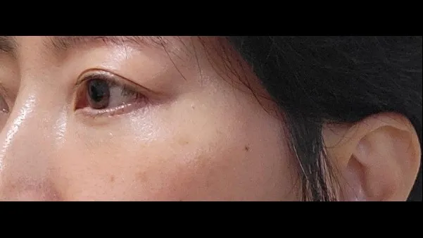 Sub-brow Lift, Lower Blepharoplasty (Aging Eye Rejuvenation), Lower Eyelid Fat Grafting — RE&RE PLASTIC SURGERY 5