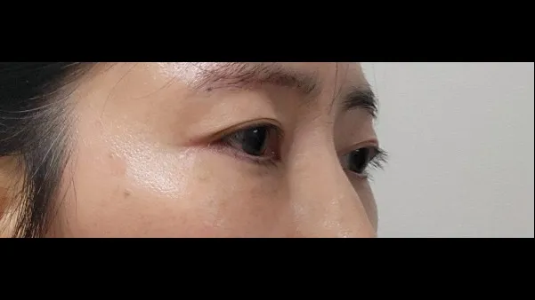 Sub-brow Lift, Lower Blepharoplasty (Aging Eye Rejuvenation), Lower Eyelid Fat Grafting — RE&RE PLASTIC SURGERY 6