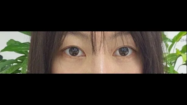 Incisional Double Eyelid Surgery — RE&RE PLASTIC SURGERY 2