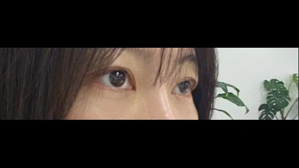 Incisional Double Eyelid Surgery — RE&RE PLASTIC SURGERY 3
