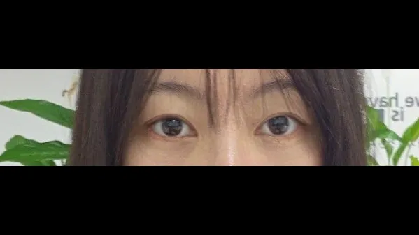 Incisional Double Eyelid Surgery — RE&RE PLASTIC SURGERY 4