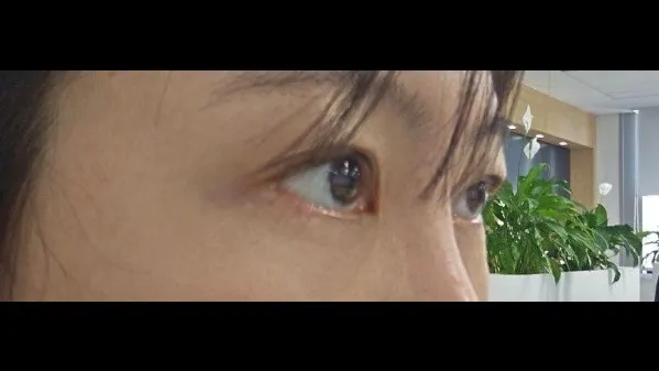 Incisional Double Eyelid Surgery — RE&RE PLASTIC SURGERY 5