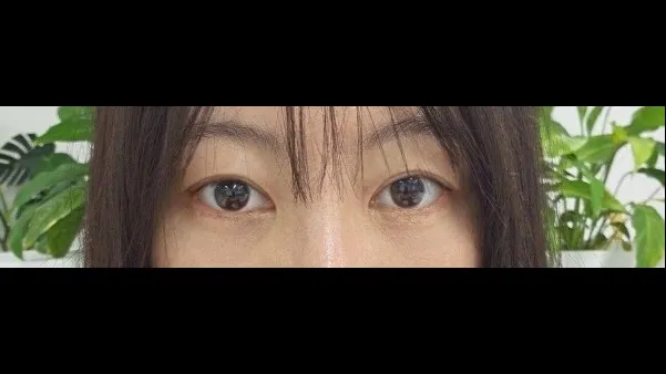 Incisional Double Eyelid Surgery — RE&RE PLASTIC SURGERY 6