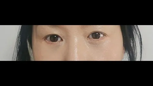 Sub-brow Lift, Lower Blepharoplasty (Aging Eye Rejuvenation) — RE&RE PLASTIC SURGERY 2