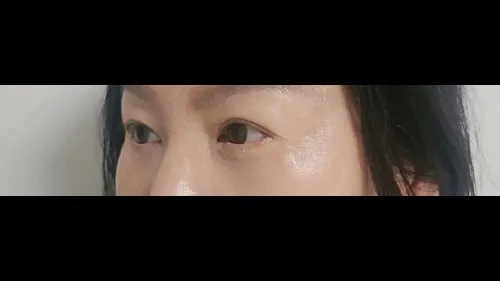 Sub-brow Lift, Lower Blepharoplasty (Aging Eye Rejuvenation) — RE&RE PLASTIC SURGERY 3