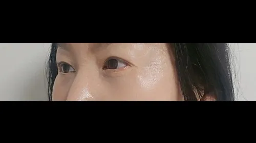 Sub-brow Lift, Lower Blepharoplasty (Aging Eye Rejuvenation) — RE&RE PLASTIC SURGERY 4