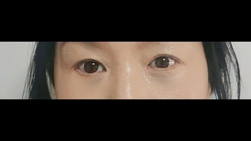 Sub-brow Lift, Lower Blepharoplasty (Aging Eye Rejuvenation) — RE&RE PLASTIC SURGERY 5