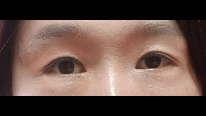 Partial Incision Double Eyelid Surgery, Ptosis Correction, Lower Blepharoplasty (Aging Eye Rejuvenation), Lower Eyelid Fat Grafting — RE&RE PLASTIC SURGERY 2