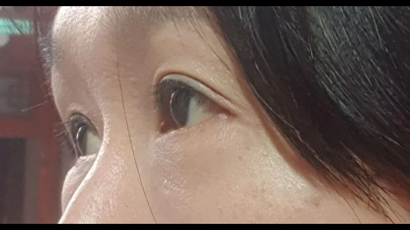 Partial Incision Double Eyelid Surgery, Ptosis Correction, Lower Blepharoplasty (Aging Eye Rejuvenation), Lower Eyelid Fat Grafting — RE&RE PLASTIC SURGERY 3