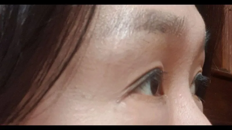 Partial Incision Double Eyelid Surgery, Ptosis Correction, Lower Blepharoplasty (Aging Eye Rejuvenation), Lower Eyelid Fat Grafting — RE&RE PLASTIC SURGERY 4