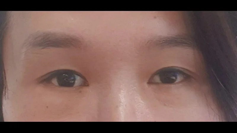 Partial Incision Double Eyelid Surgery, Ptosis Correction, Lower Blepharoplasty (Aging Eye Rejuvenation), Lower Eyelid Fat Grafting — RE&RE PLASTIC SURGERY 5