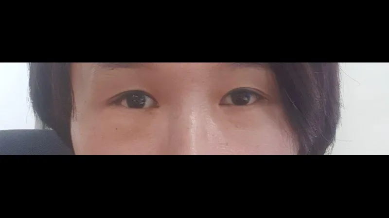 Partial Incision Double Eyelid Surgery, Ptosis Correction, Lower Blepharoplasty (Aging Eye Rejuvenation), Lower Eyelid Fat Grafting — RE&RE PLASTIC SURGERY 6