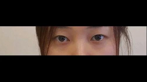 Natural Adhesion Double Eyelid Surgery, Lower Eyelid Fat Repositioning — RE&RE PLASTIC SURGERY 1