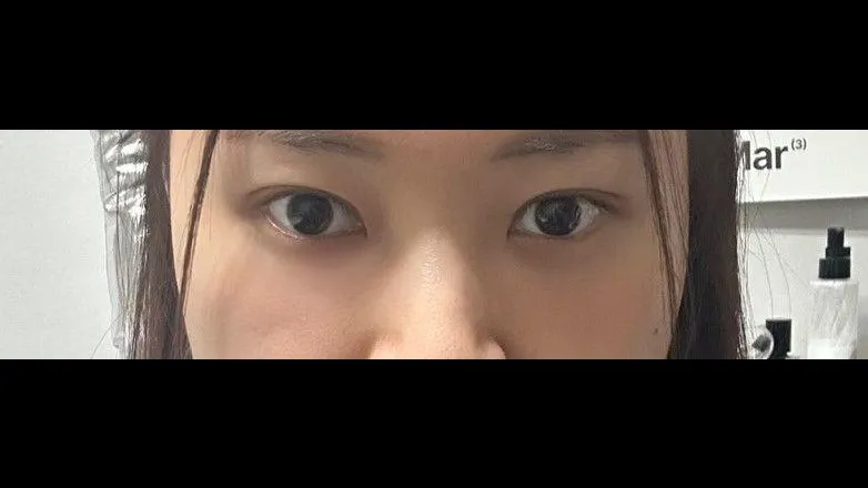 Natural Adhesion Double Eyelid Surgery, Lower Eyelid Fat Repositioning — RE&RE PLASTIC SURGERY 2