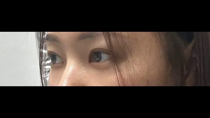 Natural Adhesion Double Eyelid Surgery, Lower Eyelid Fat Repositioning — RE&RE PLASTIC SURGERY 3