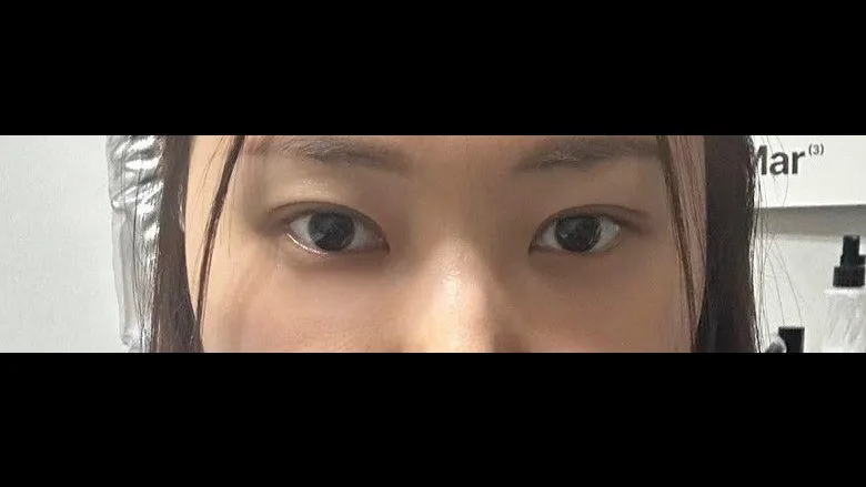 Natural Adhesion Double Eyelid Surgery, Lower Eyelid Fat Repositioning — RE&RE PLASTIC SURGERY 4