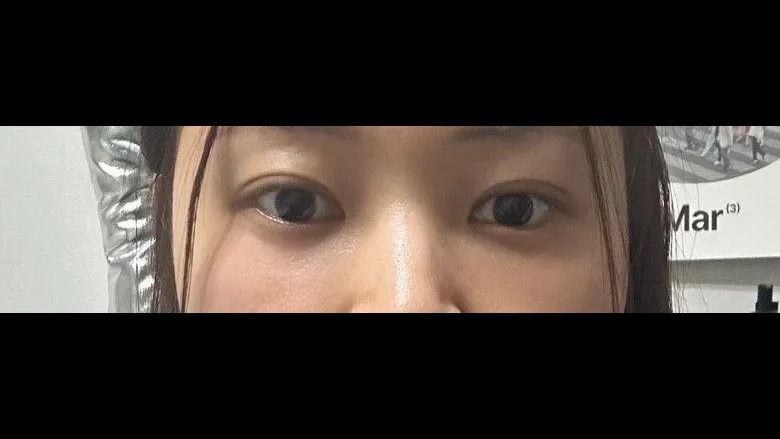 Natural Adhesion Double Eyelid Surgery, Lower Eyelid Fat Repositioning — RE&RE PLASTIC SURGERY 5