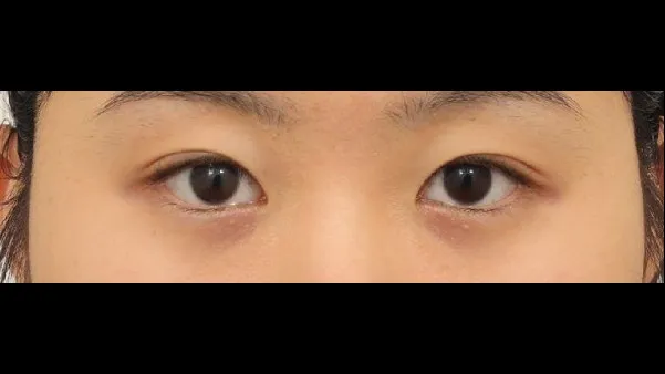 Partial Incision Double Eyelid Surgery — RE&RE PLASTIC SURGERY 2