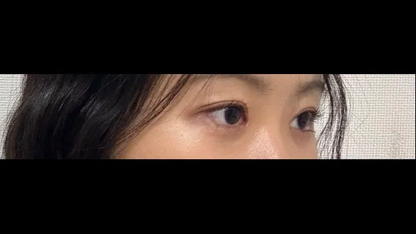 Partial Incision Double Eyelid Surgery — RE&RE PLASTIC SURGERY 3