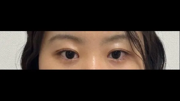 Partial Incision Double Eyelid Surgery — RE&RE PLASTIC SURGERY 4