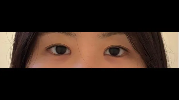 Partial Incision Double Eyelid Surgery — RE&RE PLASTIC SURGERY 5