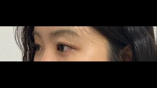 Partial Incision Double Eyelid Surgery — RE&RE PLASTIC SURGERY 6