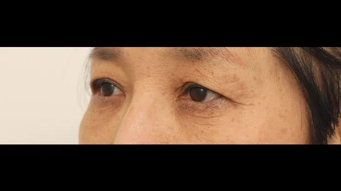 Sub-brow Lift, Lower Blepharoplasty (Aging Eye Rejuvenation) — RE&RE PLASTIC SURGERY 2