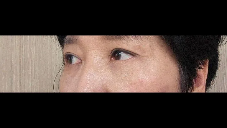 Sub-brow Lift, Lower Blepharoplasty (Aging Eye Rejuvenation) — RE&RE PLASTIC SURGERY 3