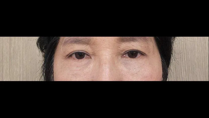 Sub-brow Lift, Lower Blepharoplasty (Aging Eye Rejuvenation) — RE&RE PLASTIC SURGERY 4