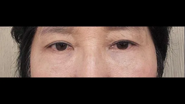 Sub-brow Lift, Lower Blepharoplasty (Aging Eye Rejuvenation) — RE&RE PLASTIC SURGERY 5