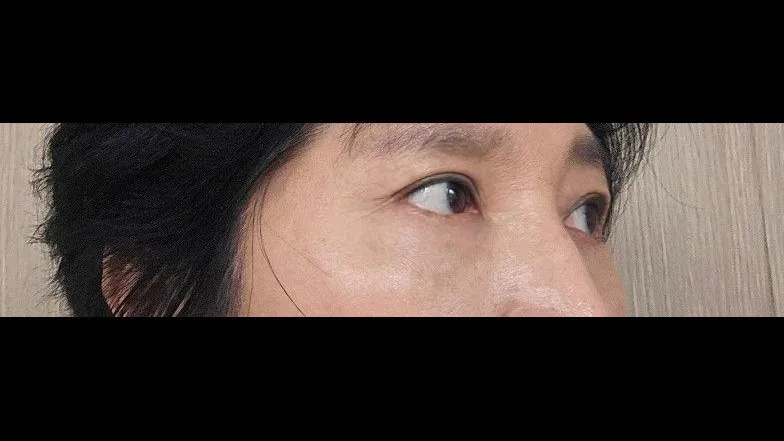 Sub-brow Lift, Lower Blepharoplasty (Aging Eye Rejuvenation) — RE&RE PLASTIC SURGERY 6