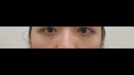 Lower Eyelid Fat Grafting, Nasal Tip — RE&RE PLASTIC SURGERY 1